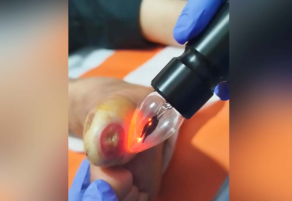 Curso de ozono láser